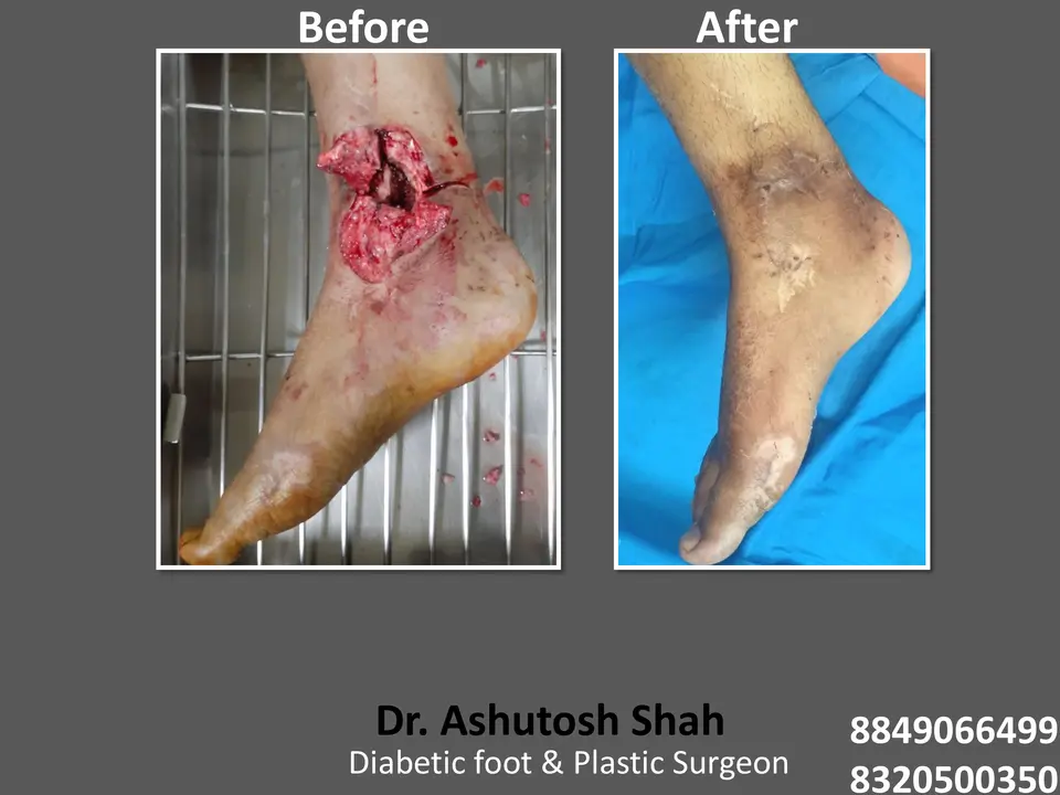 Diabetic Foot  PPT sunita.pptx-54.webp